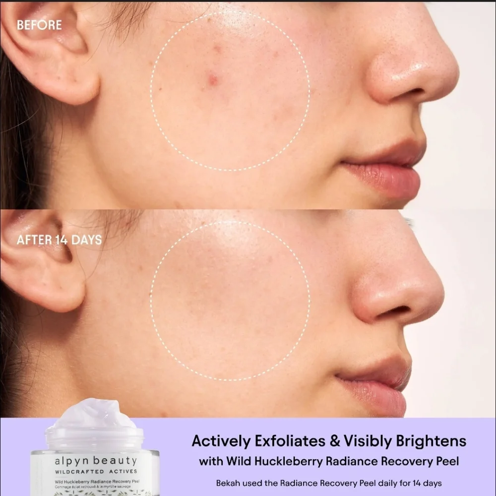 Alpyn Beauty | Wild Huckleberry Radiance Recovery Peel 1.7 Fl Oz/50 mL